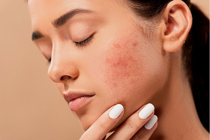 Как подобрать крем для проблемной кожи лица